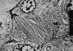 M,55y. | plasmocytoma M,55y. | plasmocytoma